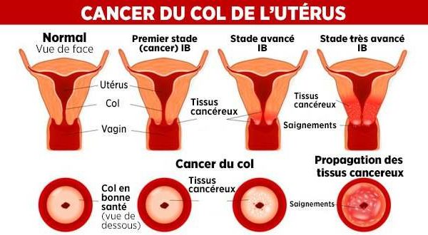 Le Tchad en guerre contre le cancer et le col de l’utérus