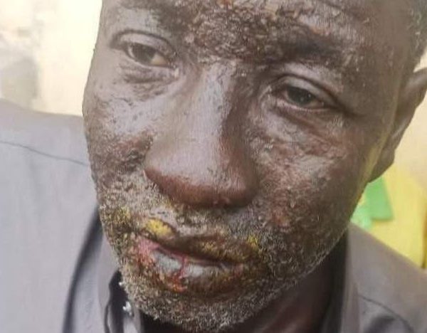 Guinée : Des pêcheurs atteints d’une mystérieuse maladie de peau