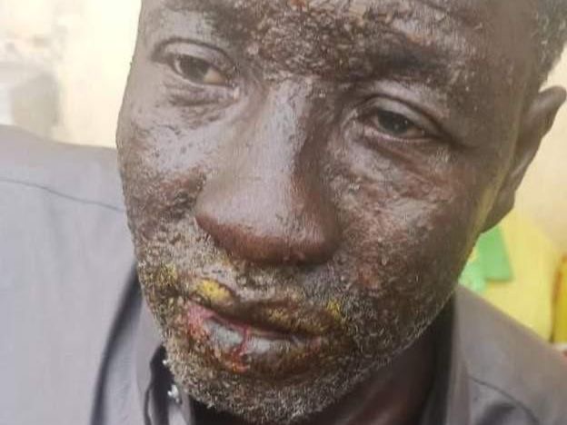 Guinée : Des pêcheurs atteints d'une mystérieuse maladie de peau 1