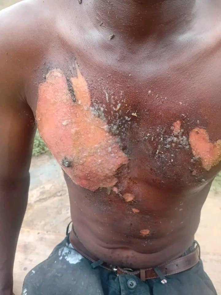 N’Djamena : une dispute conjugale dégénère, un homme brûlé à l’eau bouillante 1